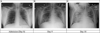 Case Report: Tocilizumab for the Treatment of SARS-CoV-2 Infection in a Patient With Aplastic Anemia